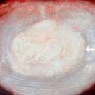 disc disease